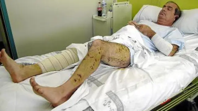 17 de enero de 2010. Como consecuencia del ataque de una jauría, Ramón Rubira, de Burriana (Castellón), sufrió heridas por todo el cuerpo.
