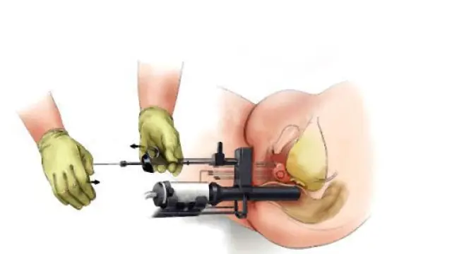 El Servet pondrá también en marcha una técnica poco invasiva para el cáncer de próstata