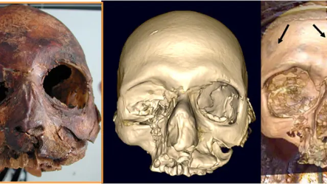 Puntos coincidentes entre el TAC del cráneo del papa Luna y el busto de San Valero