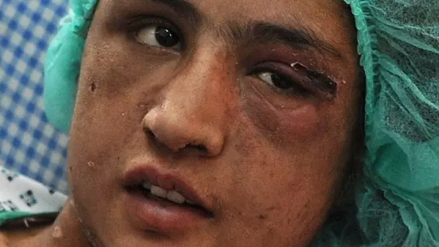 La joven afgana Sahar Gul recibe tratamiento médico en un hospital de Kabul.
