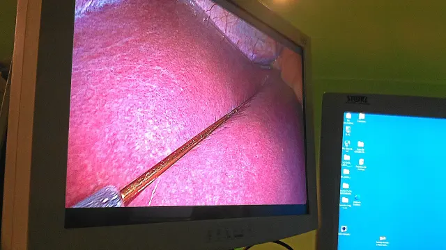 Imagen, durante una intervención de laparoscopia, en la que se observa un electrodo sobre el hígado para medir su gracia