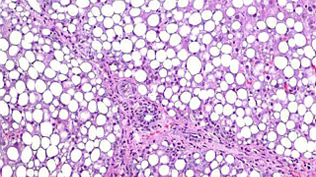 Imagen de un hígado graso de un paciente obeso con una infiltración grasa de las células hepáticas (hepatocitos) en una proporción del 70%