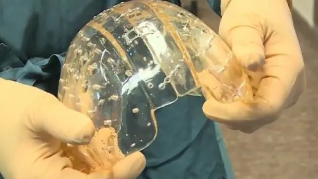 Imagen del cráneo de plástico implantado.