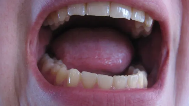 Una dieta poco equilibrada amarillea el tono de los dientes