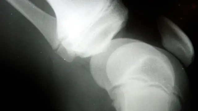 Radiografía de una rodilla