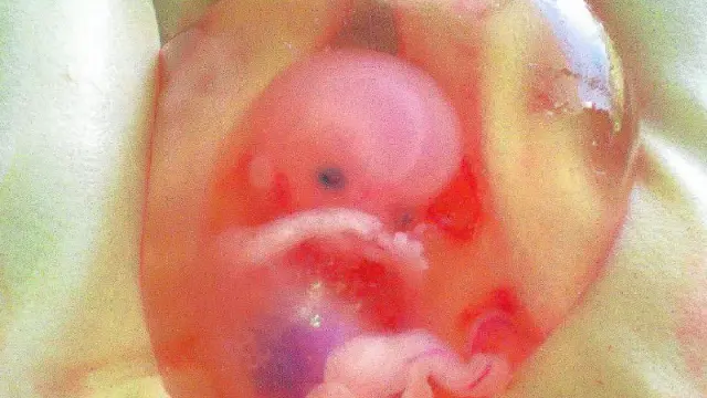 Embrión de 10 semanas, dentro de su saco amniótico.
