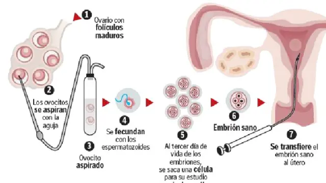 Proceso de selección de embrión sano por la técnica del diagnóstico genético preimplantacional.