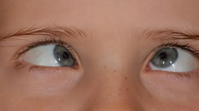 El estrabismo es un defecto visual que consiste en la pérdida de paralelismo de los ojos y es una de las complicaciones más frecuentes en niños pequeños.