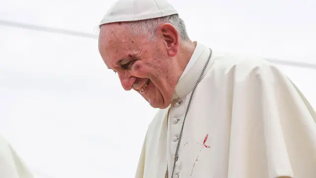 El pequeño golpe en la cara del papa Francisco le dejó la zona de la ceja y el pómulo visiblemente amoratada.