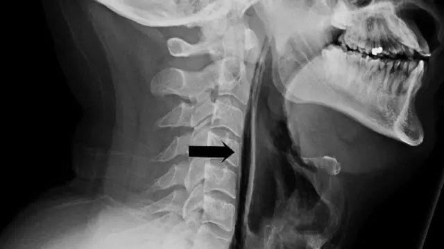 La radiografía muestra la dilatación en el cuello del paciente tras frenar un estornudo.