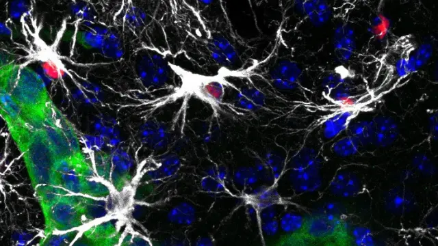 Células metastásicas en el cerebro (verde) rodeadas por astrocitos reactivos (blanco). Algunos con la vía de Stat3 activada (rojo)