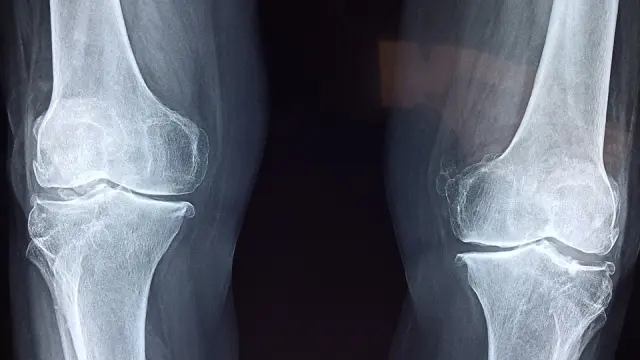 La fragilidad ósea raramente se detecta antes de la primera fractura.