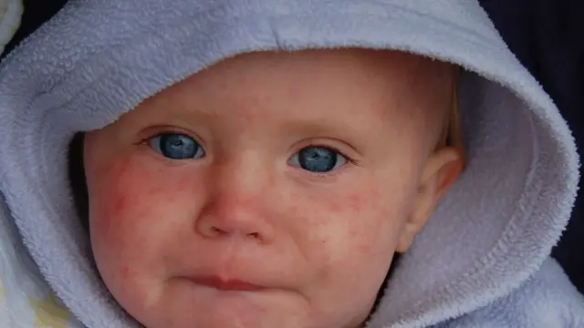 Unos días después de que suba la fiebre, se produce una erupción rojiza en la piel que comienza en la cara.