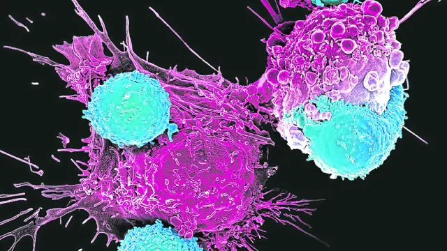 Células CAR-T (linfocitos T del paciente modificado) atacando células tumorales