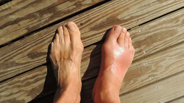 Los pies suelen hincharse en verano como consecuencia del calor