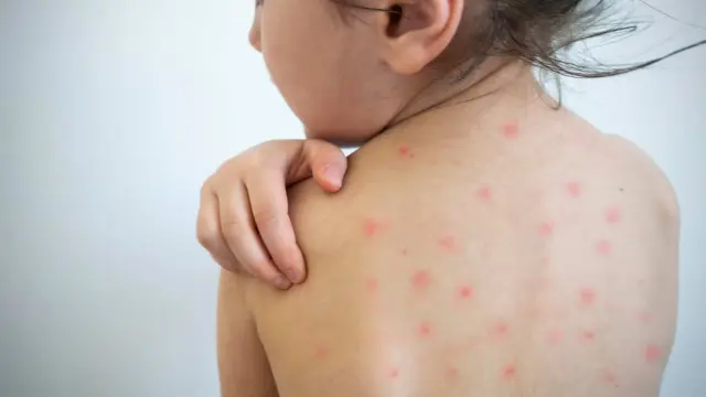 La erupción de la varicela se caracteriza por ampollas y el sarampión forma manchas que se extienden por el cuerpo.
