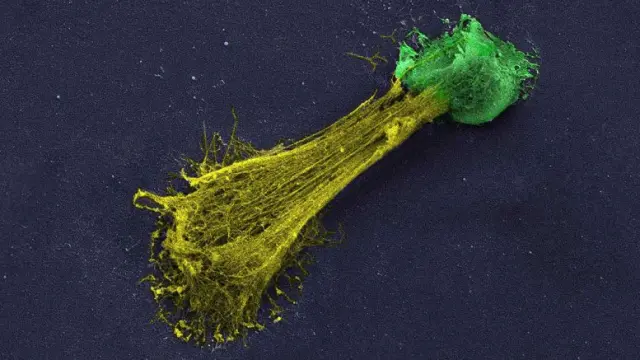 Neutrófilo (verde) lanzando una red de ADN (amarillo).