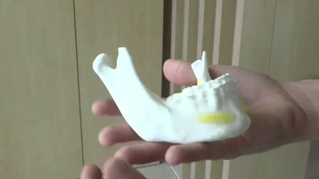 Sant Joan de Déu extrae una aguja de dentista del cerebro de una niña de cuatro años