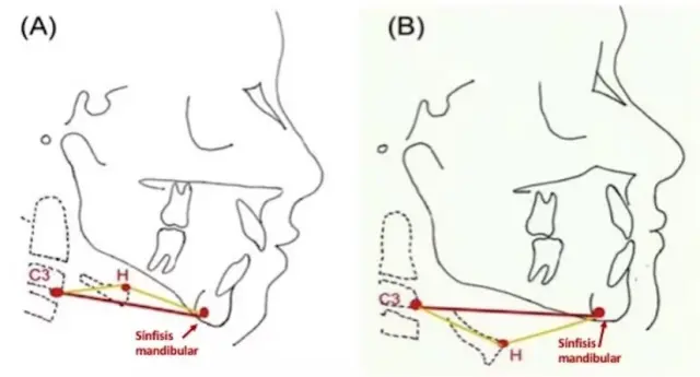 A. Respirador habitual por la boca. Posición elevada del hueso hioides (H) con respecto a la línea formada por la 3ª vértebra cervical (C3) la parte más posterior de la sínfisis mandibular, leve cresta donde se unen las dos piezas de la mandíbula. B. Respirador habitual por la nariz. El hueso hioides está por debajo de la línea que forma C3 y la sínfisis mandibular.