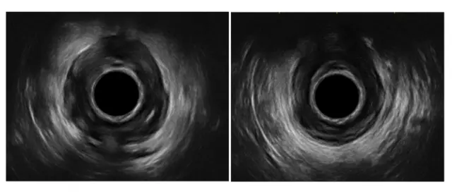 La ecografía endoanal permite obtener imágenes mediante ultrasonidos y es uno de los mayores avances de la última década en la evaluación de la enfermedad anorrectal.