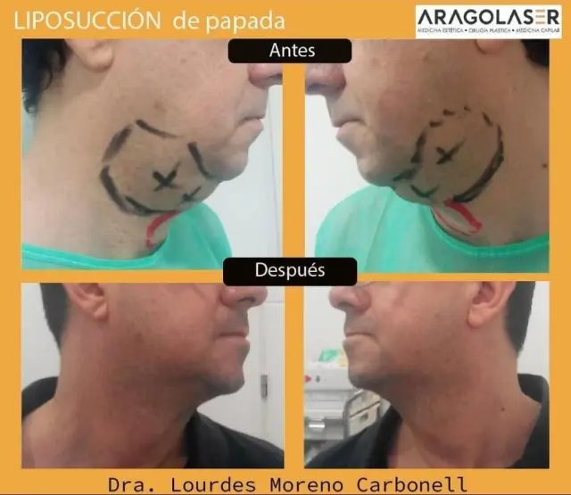 Resultado de una intervención de La doctora Lourdes Moreno Carbonell.