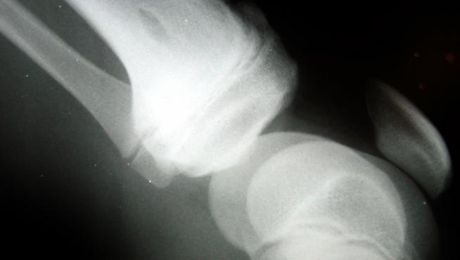 Radiografía de una rodilla