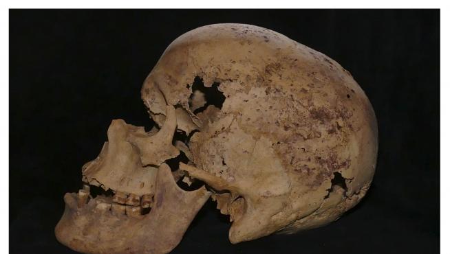 Fotografía facilitada por el Ministerio egipcio de Antigüedades de los restos de la mujer que sufrió cáncer de pecho.