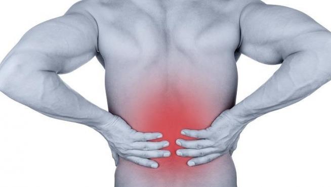 Los cálculos renales pueden provocar dolores intensos en la zona baja de la espalda.