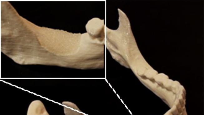 Modelo de implante corrector de un defecto óseo impreso en 3D por deposición de fundente