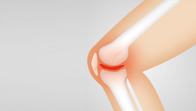 La artritis provoca que la membrana sinovial que protege y lubrica las articulaciones se inflame y cause dolor e hinchazón