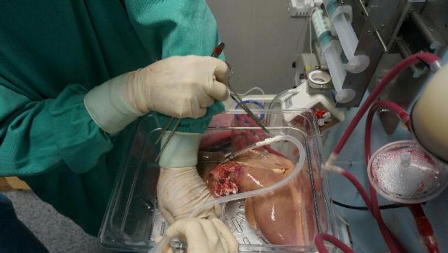 Un trasplante de hígado.