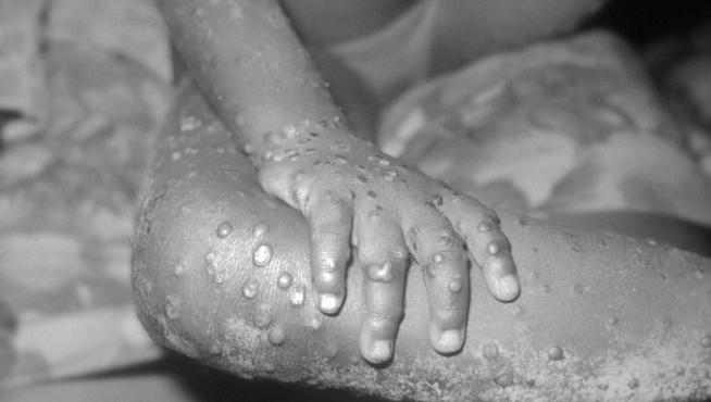 El mayor riesgo de contagio se da entre quienes tienen contacto físico cercano con alguien infectado y con síntomas. Human infection with monkeypox-like virus in 4 year-old female, Bondua, Grand Gedeh County, Liberia. Infection was caused by a pox virus of the vaccinea, variola, monkeypox type. 1971 tray #26, B71-990