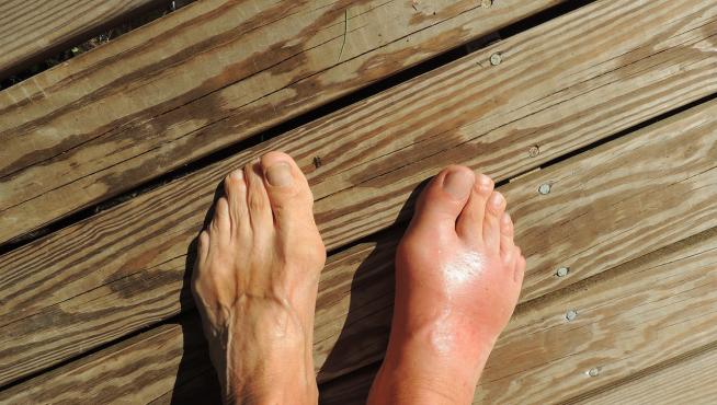 Los pies suelen hincharse en verano como consecuencia del calor