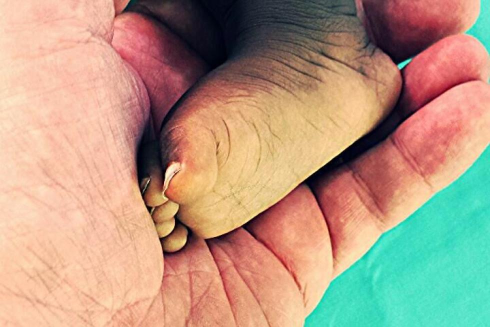 África y Europa colaborando juntas contra la hidrocefalia. En la imagen, el autor del documental 'Un hospital en África' sostiene en su mano el pie de una niña.