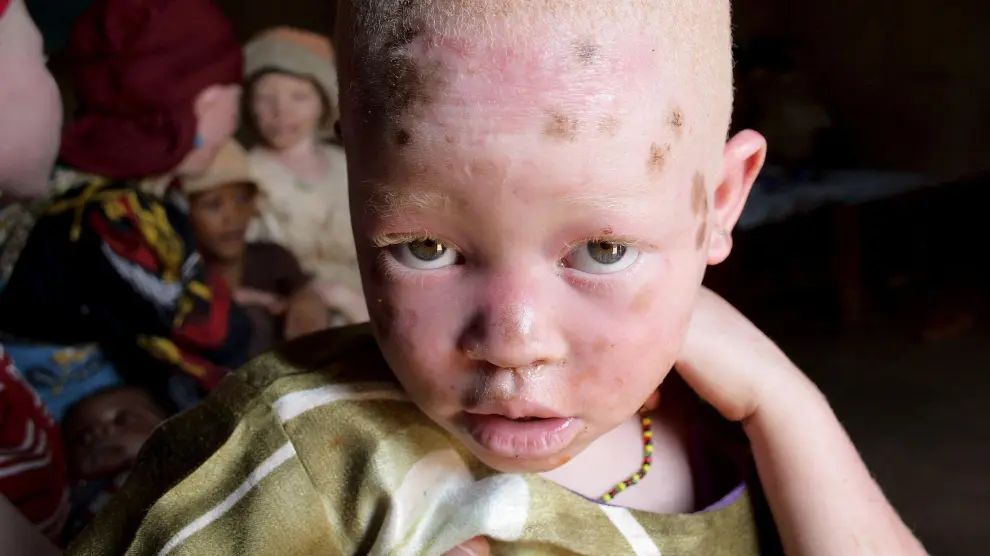 Niño albino africano