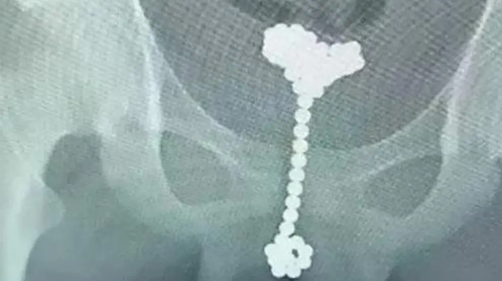 Radiografía del niño donde se observan 31 bolas magnéticas en el pene.