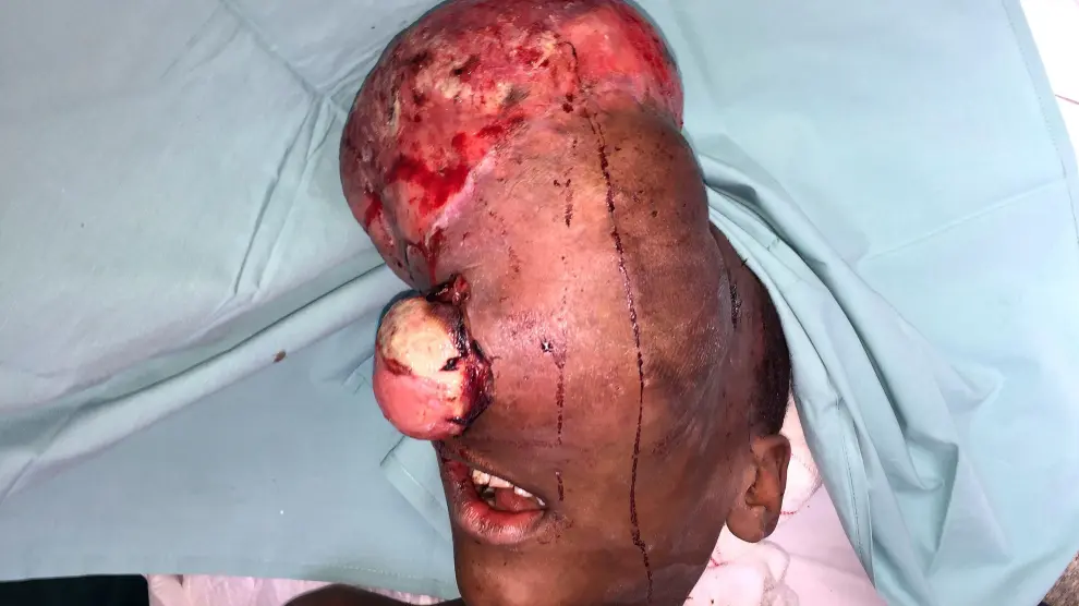 El pequeño, con el tumor en la cara antes de ser operado.