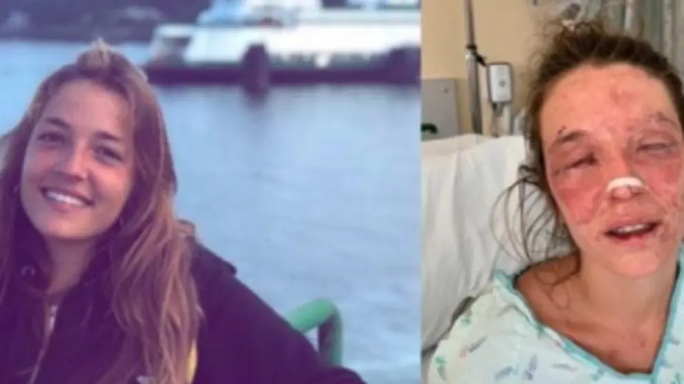 Marta Bustos antes y después del accidente