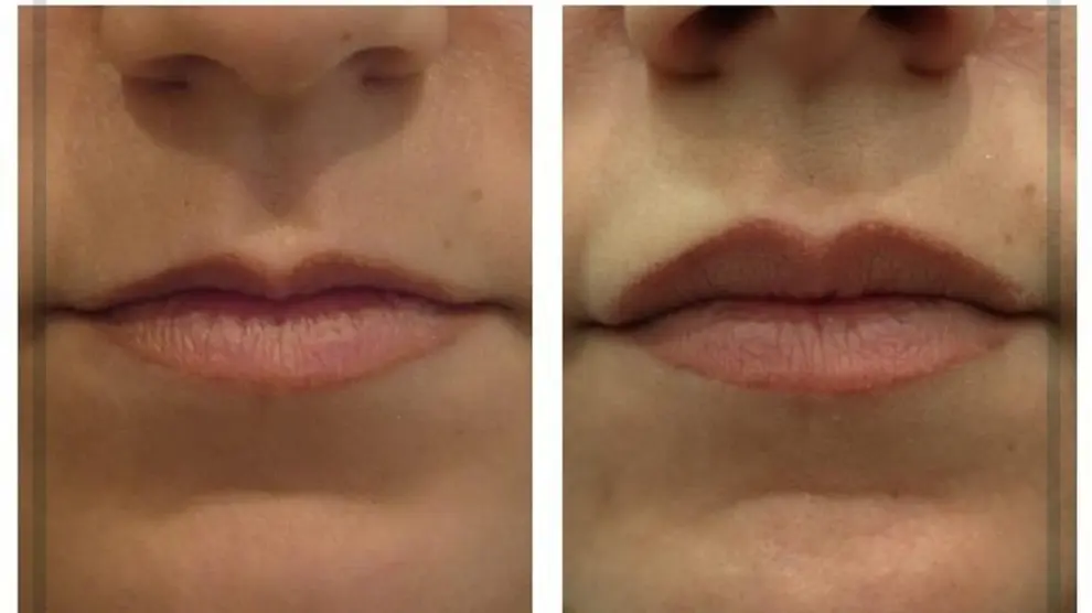 Relleno de labios realizado en la clínica Renobell con ácido hialuronico.