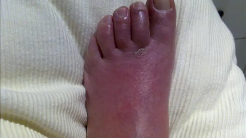 Un pie afectado por una reacción alérgica