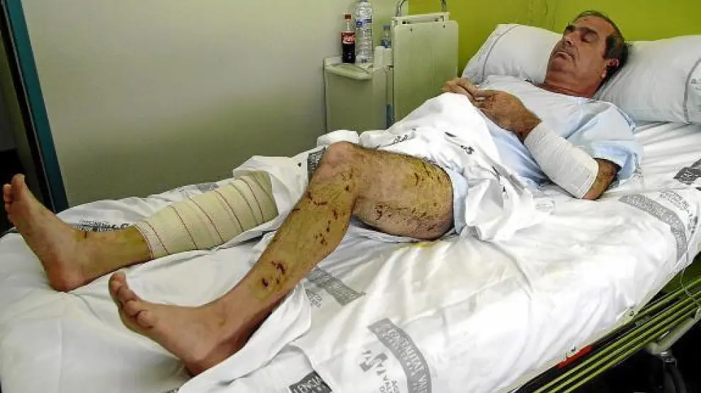 Ramón Rubira, con múltiples cicatrices, en su cama del hospital de Villarreal