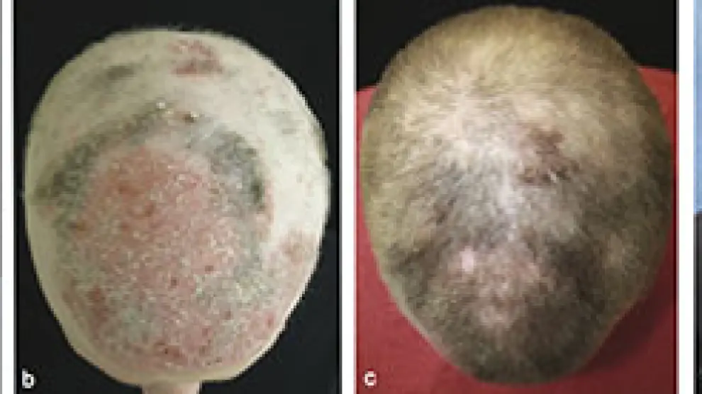 En ocho meses, el paciente recuperó el pelo