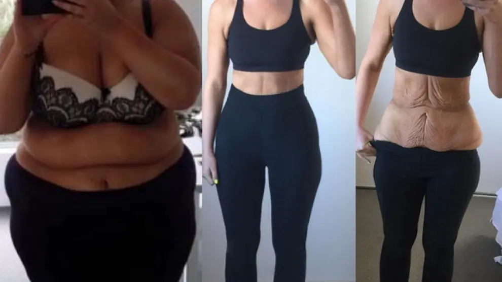 Imagen que prueba cómo Simone Anderson fue capaz de adelgazar 80 kilos