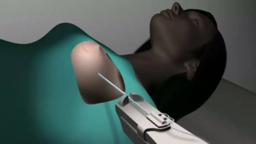 Recreación en 3D de una paciente, sometiéndose a un tratamiento de radioterapia contra el cáncer de mama.