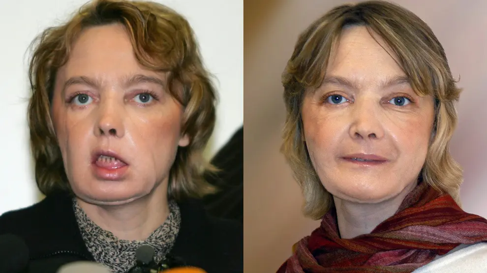Imagen de archivo de Isabelle Dinoire antes y después de la operción