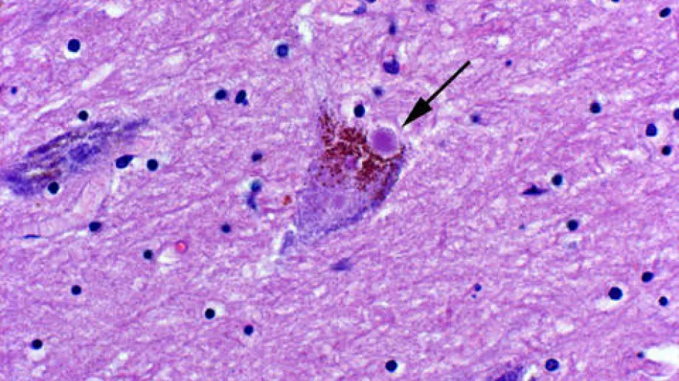 Una neurona con cuerpos de Lewy, las estructuras neurotóxicas características de un cerebro con párkinson