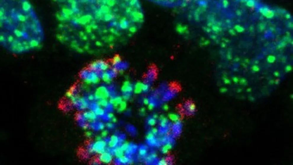 Célula tumoral tratada con los inhibidores de ATR desarrollados en el CNIO. En verde, las roturas en el ADN de las células generadas por el tratamiento. En azul, los cromosomas