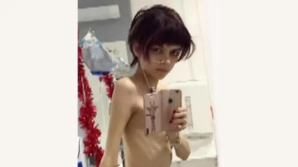 Una joven británica muestra su recuperación tras luchar contra la anorexia