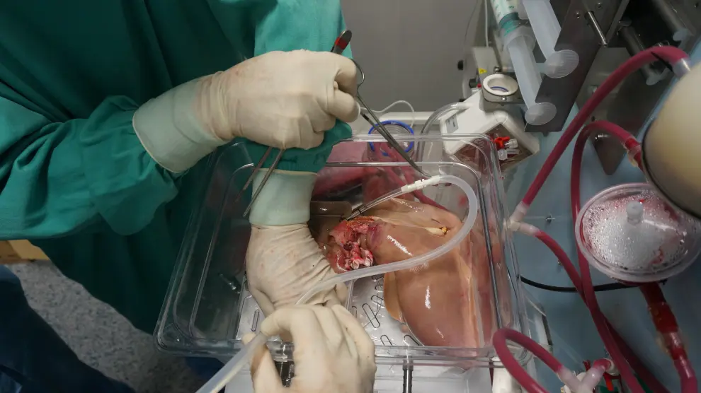 Los cirujanos conectan al dispositivo de preservación un hígado que ha sido preservado con anterioridad en frío