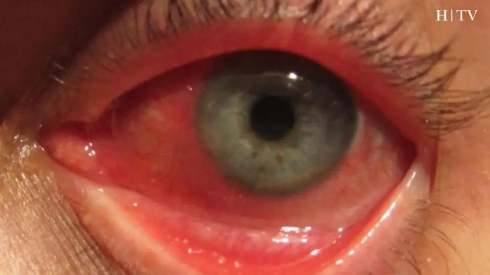 ¿Cómo tratar los ojos rojos?